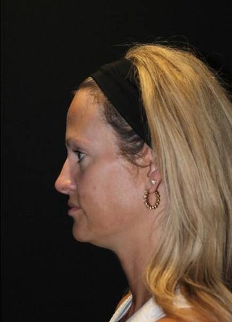 Necklift Before & After Gallery - Patient 556205 - Image 5