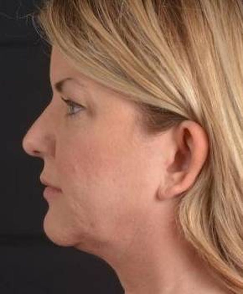 Facelift Before & After Gallery - Patient 481884 - Image 3