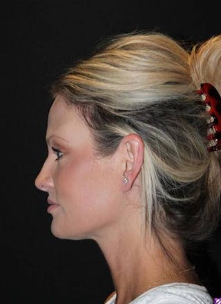 Necklift Before & After Gallery - Patient 556205 - Image 6