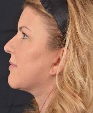 Facelift Before & After Gallery - Patient 481884 - Image 4