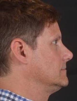 Rhinoplasty Before & After Gallery - Patient 361178 - Image 6