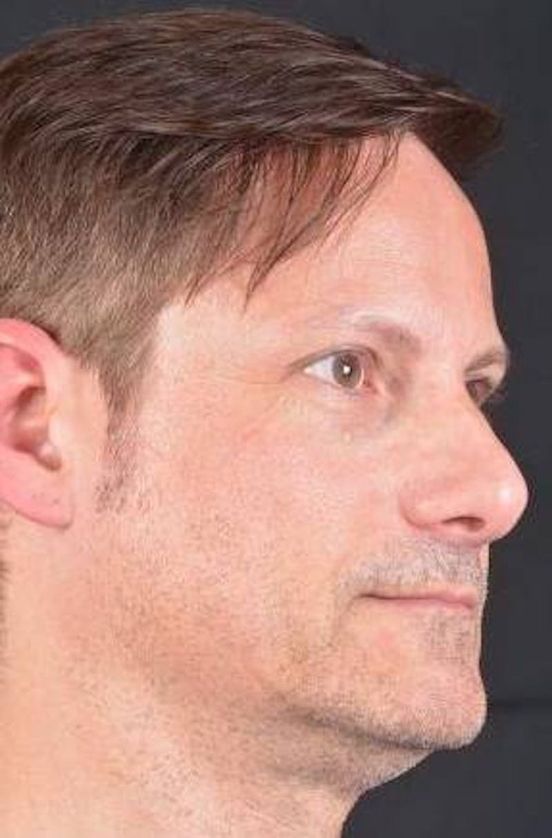 Rhinoplasty Before & After Gallery - Patient 361178 - Image 9