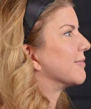 Facelift Before & After Gallery - Patient 481884 - Image 6