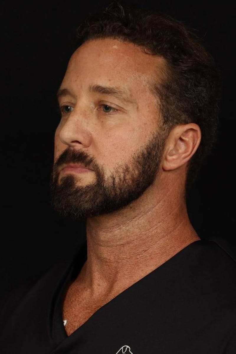 Necklift Before & After Gallery - Patient 387241 - Image 3