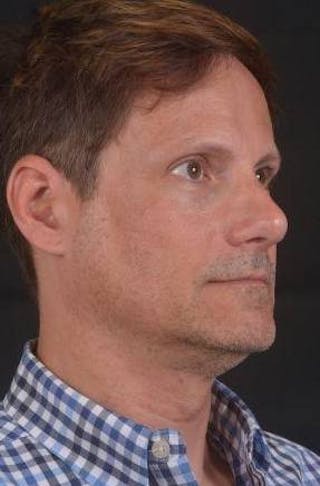 Rhinoplasty Before & After Gallery - Patient 361178 - Image 10