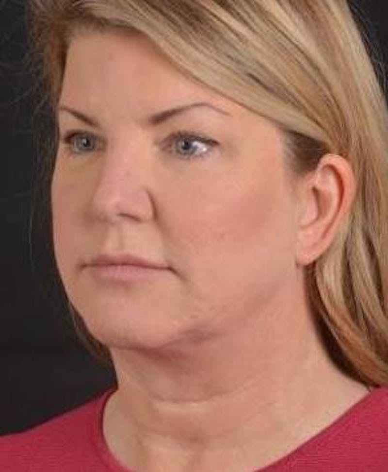 Facelift Before & After Gallery - Patient 481884 - Image 7