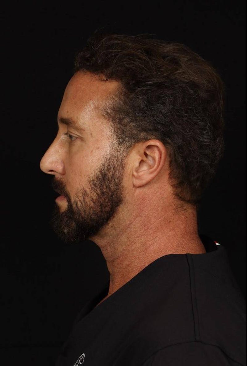 Necklift Before & After Gallery - Patient 387241 - Image 5