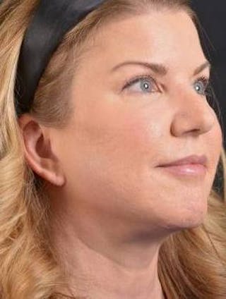 Facelift Before & After Gallery - Patient 481884 - Image 10