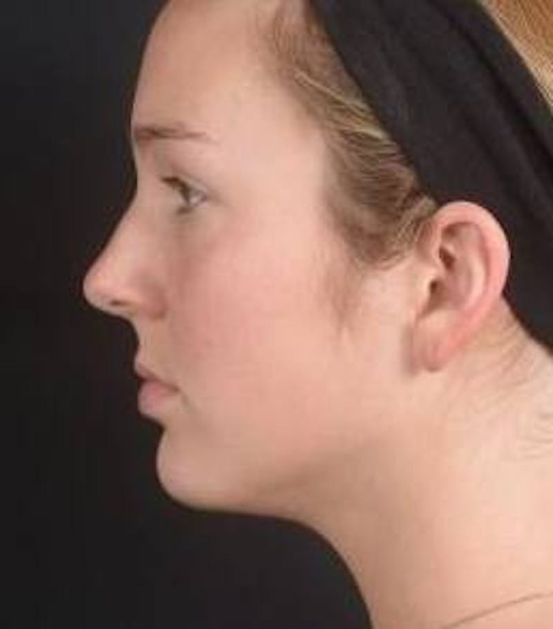 Rhinoplasty Before & After Gallery - Patient 273786 - Image 3