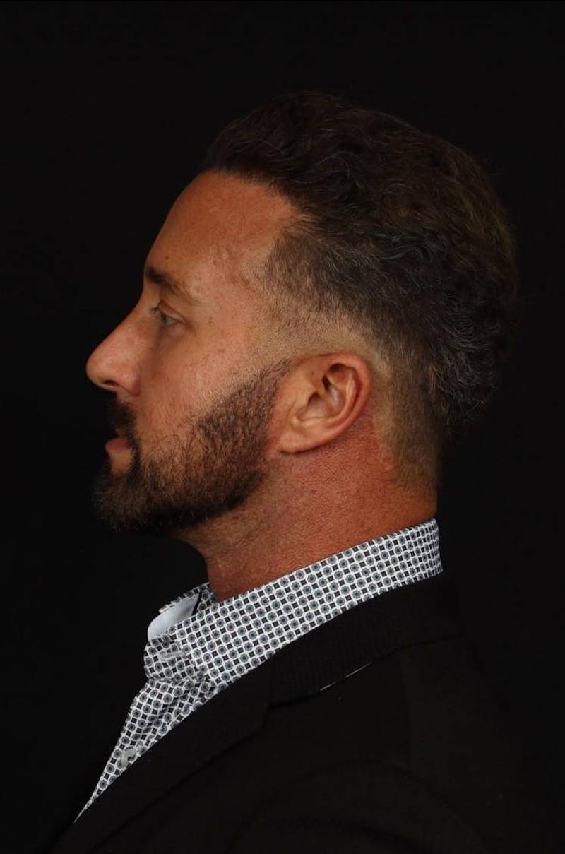 Necklift Before & After Gallery - Patient 387241 - Image 6