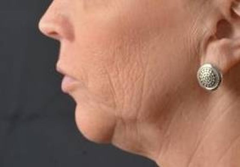 Facelift Before & After Gallery - Patient 129408 - Image 3