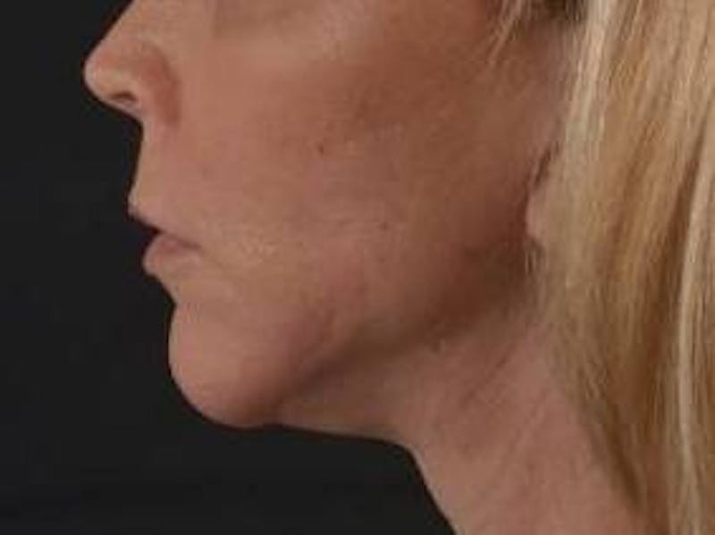 Facelift Before & After Gallery - Patient 129408 - Image 4