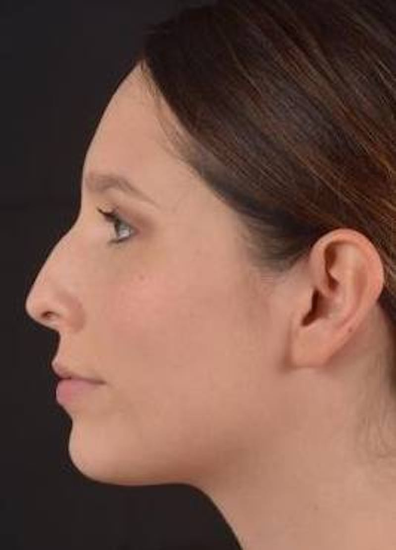 Rhinoplasty Before & After Gallery - Patient 411184 - Image 3