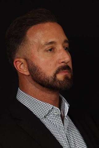 Necklift Before & After Gallery - Patient 387241 - Image 8