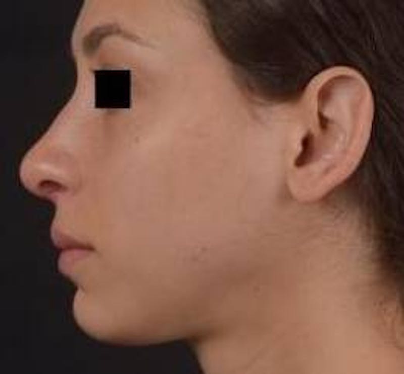 Rhinoplasty Before & After Gallery - Patient 111055 - Image 4