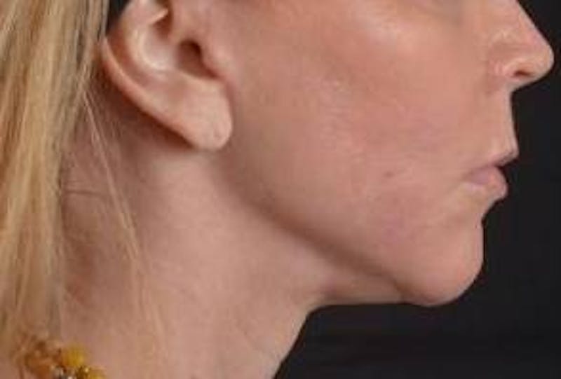 Facelift Before & After Gallery - Patient 129408 - Image 6
