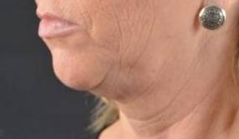 Facelift Before & After Gallery - Patient 129408 - Image 7