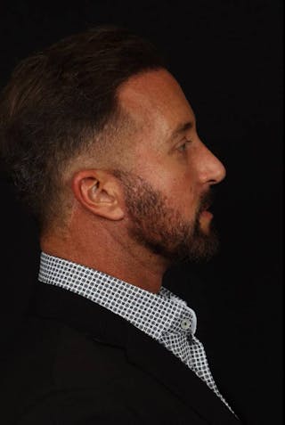 Necklift Before & After Gallery - Patient 387241 - Image 10