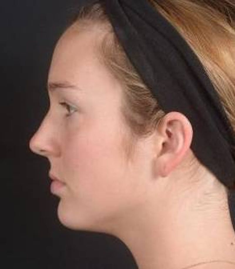 Rhinoplasty Before & After Gallery - Patient 230823 - Image 3
