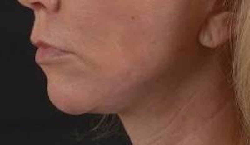 Facelift Before & After Gallery - Patient 129408 - Image 8