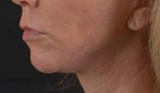 Facelift Before & After Gallery - Patient 129408 - Image 8