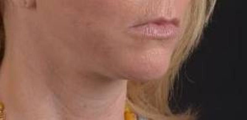 Facelift Before & After Gallery - Patient 129408 - Image 10