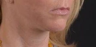 Facelift Before & After Gallery - Patient 129408 - Image 10