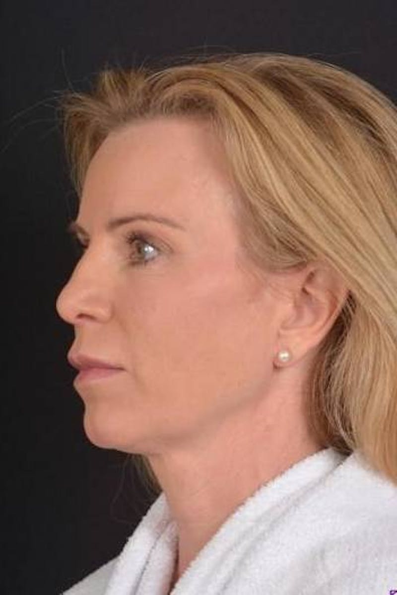 Necklift Before & After Gallery - Patient 938209 - Image 3