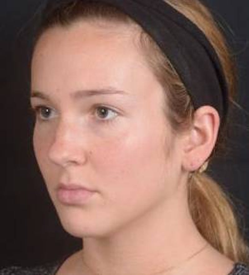 Rhinoplasty Before & After Gallery - Patient 230823 - Image 5