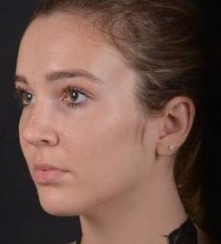 Rhinoplasty Before & After Gallery - Patient 230823 - Image 6