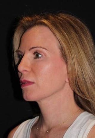 Necklift Before & After Gallery - Patient 938209 - Image 4