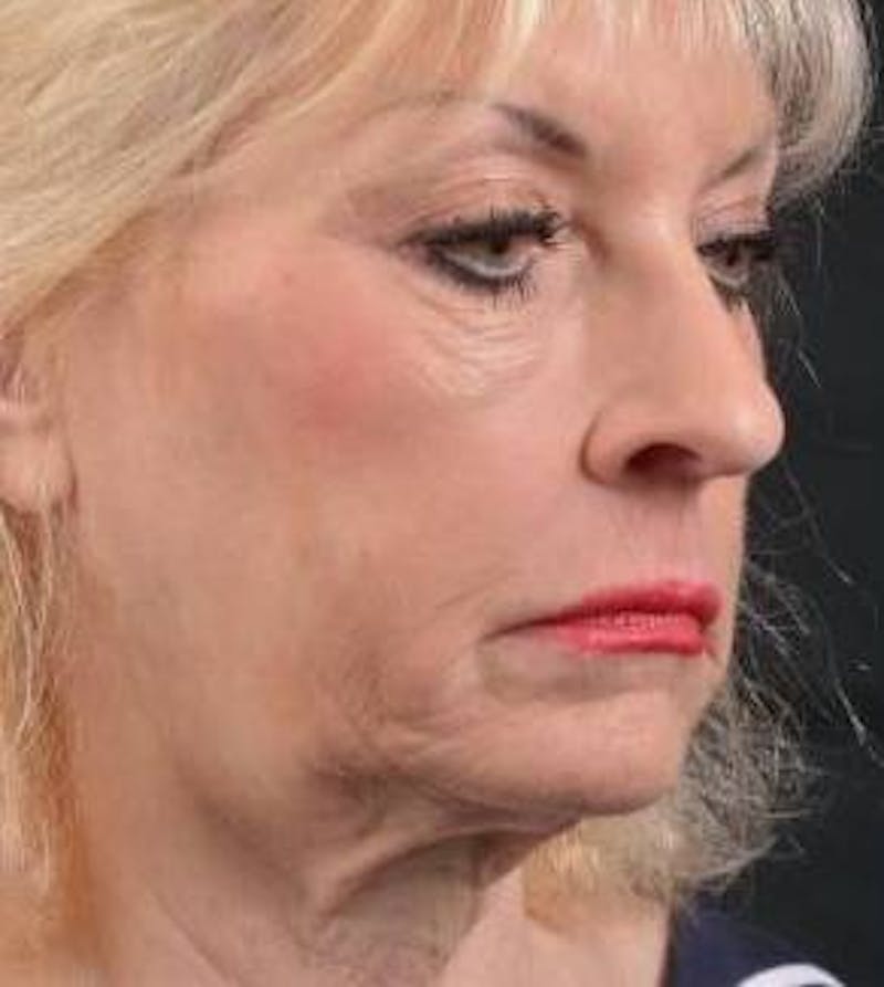 Facelift Before & After Gallery - Patient 159397 - Image 9