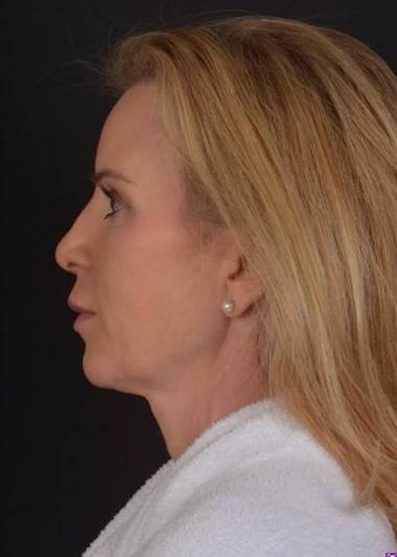 Necklift Before & After Gallery - Patient 938209 - Image 5