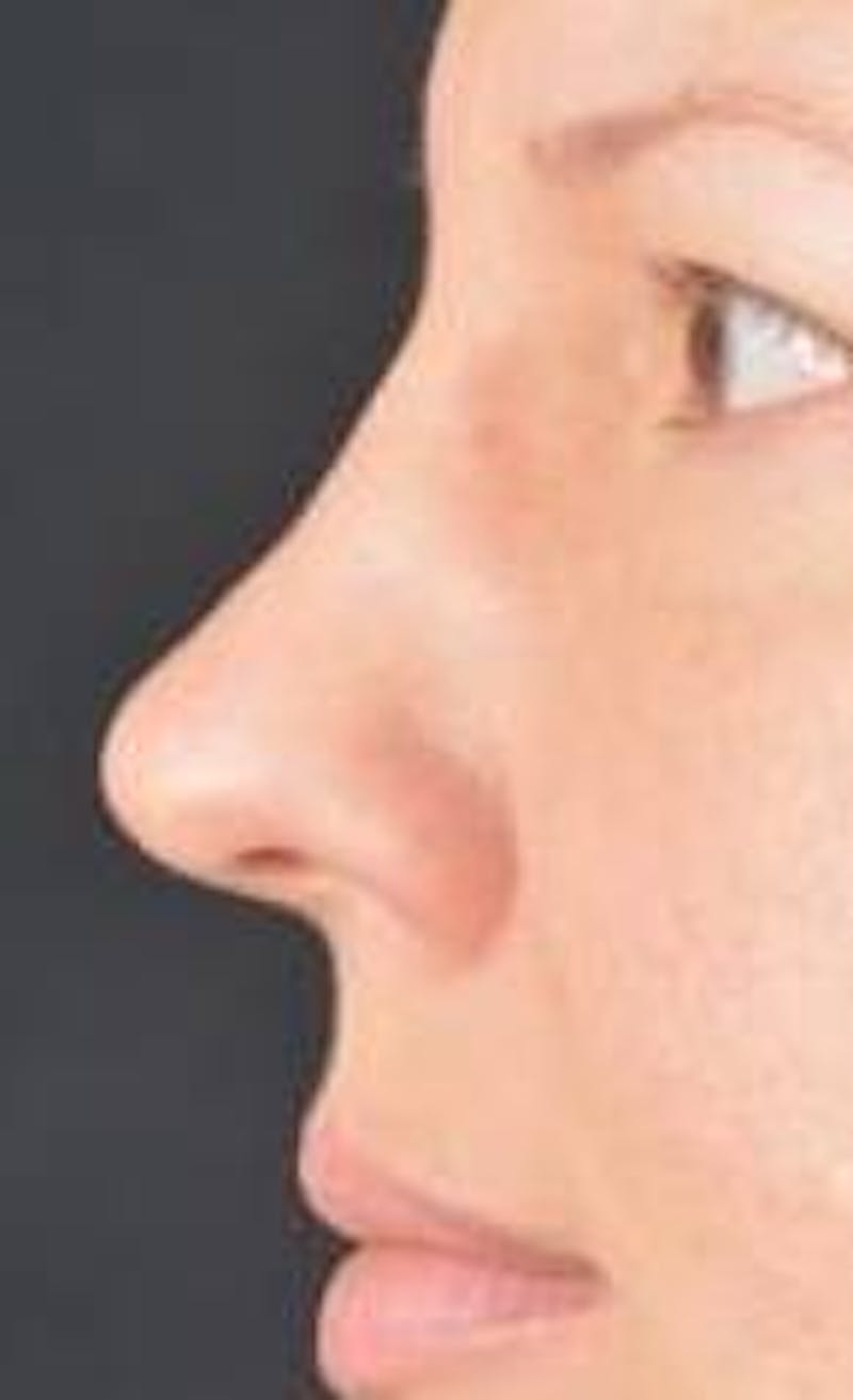 Rhinoplasty Before & After Gallery - Patient 483105 - Image 3