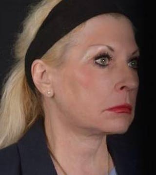 Facelift Before & After Gallery - Patient 159397 - Image 10