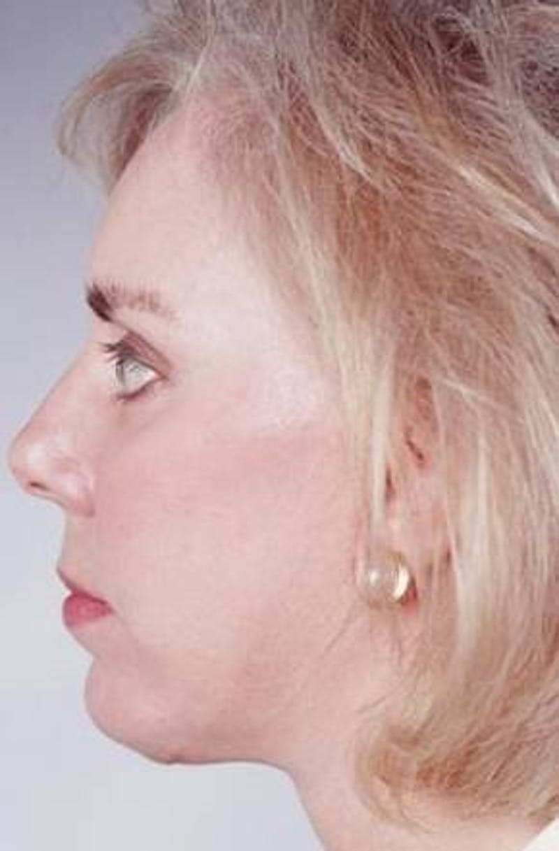 Facelift Before & After Gallery - Patient 338810 - Image 4