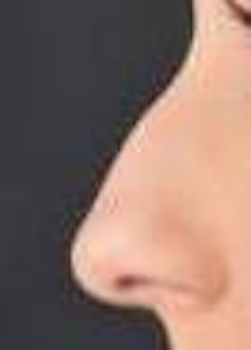 Rhinoplasty Before & After Gallery - Patient 309432 - Image 3
