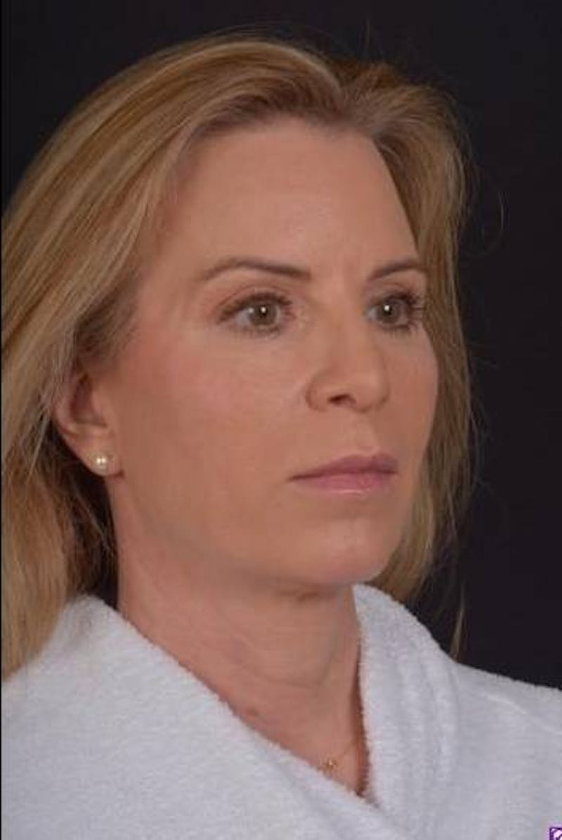 Necklift Before & After Gallery - Patient 938209 - Image 7