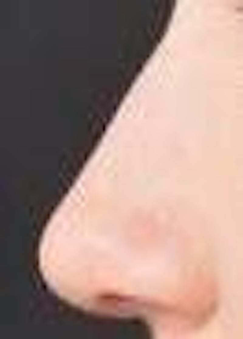 Rhinoplasty Before & After Gallery - Patient 309432 - Image 4