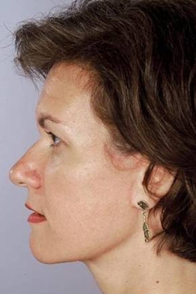 Facelift Before & After Gallery - Patient 260828 - Image 4