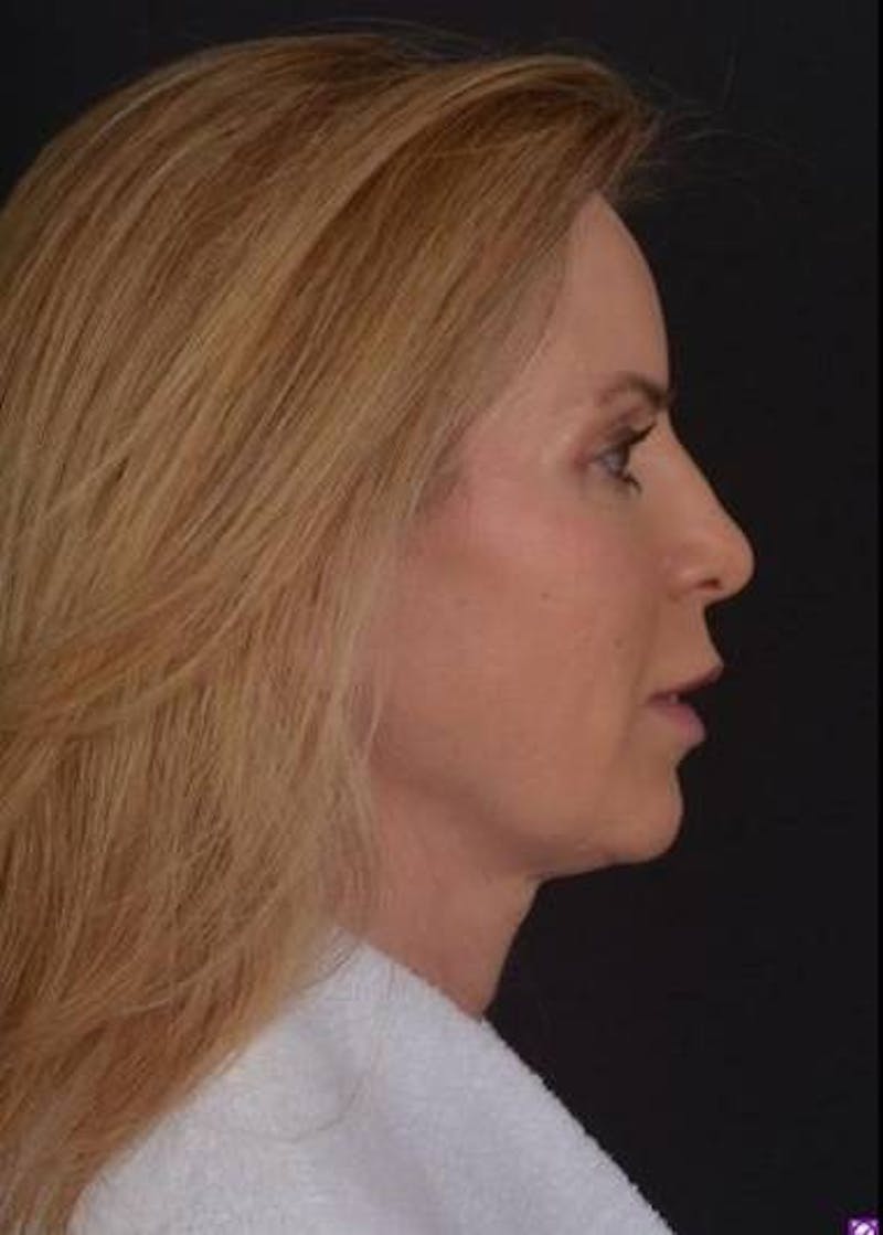 Necklift Before & After Gallery - Patient 938209 - Image 9