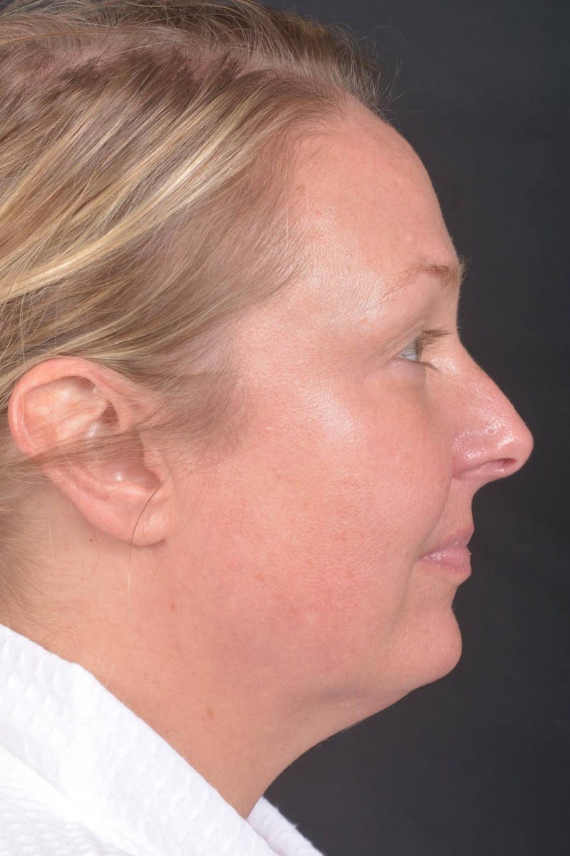 Facelift Before & After Gallery - Patient 125952 - Image 3