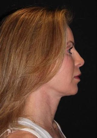 Necklift Before & After Gallery - Patient 938209 - Image 10
