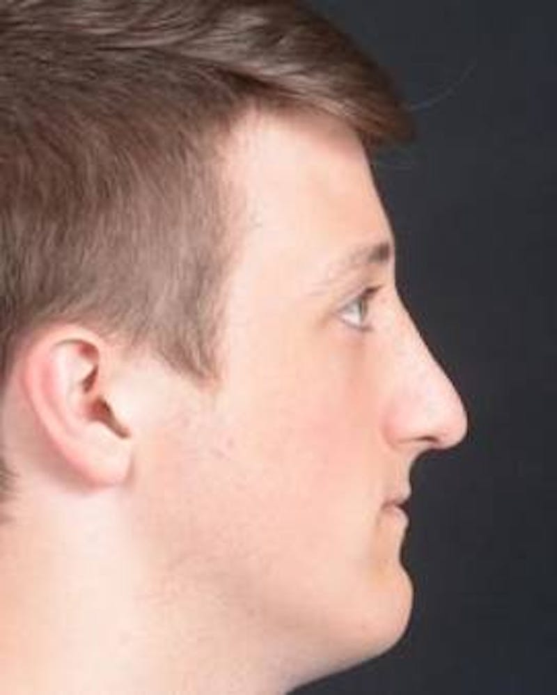 Rhinoplasty Before & After Gallery - Patient 311849 - Image 4