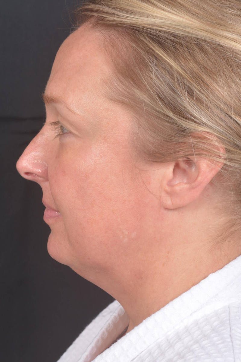 Facelift Before & After Gallery - Patient 125952 - Image 5
