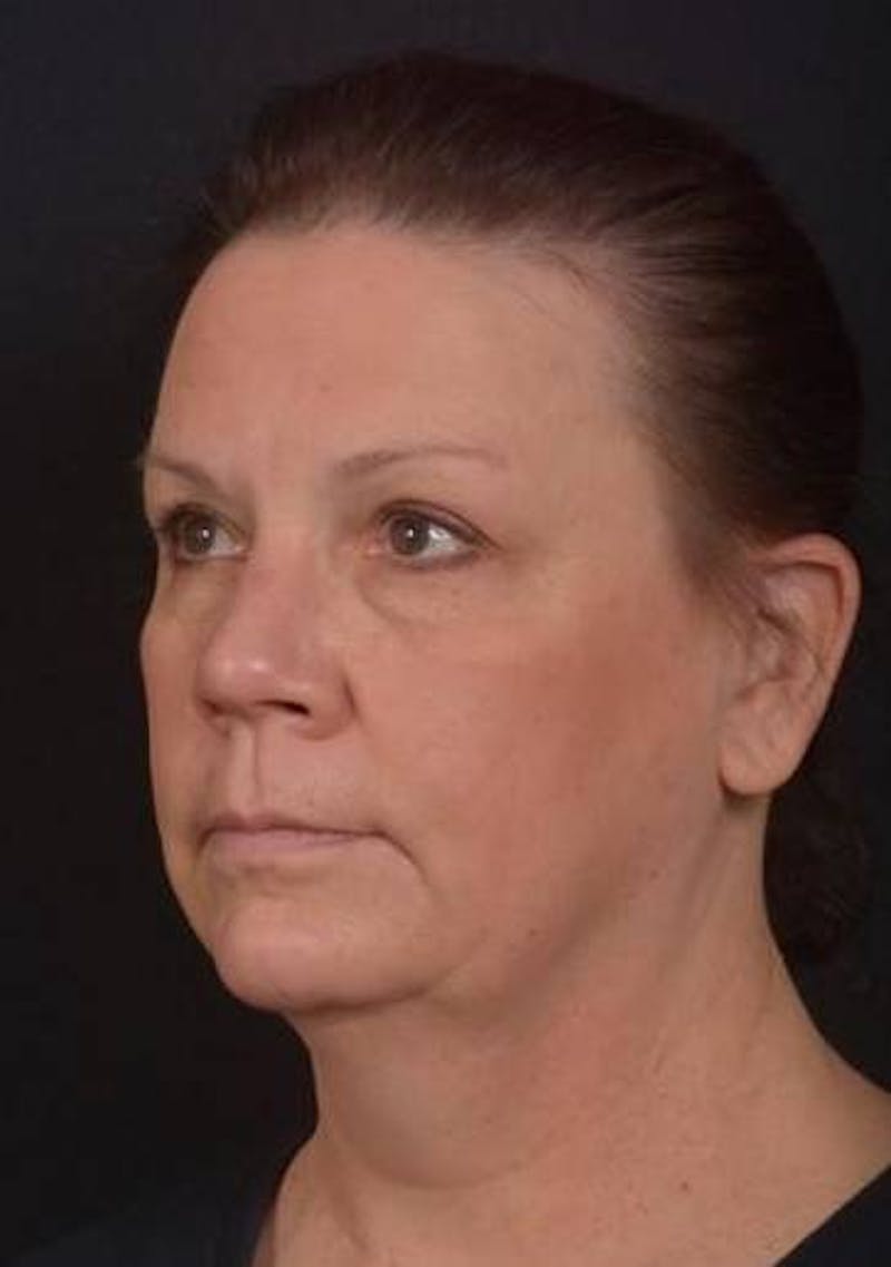 Necklift Before & After Gallery - Patient 374539 - Image 3