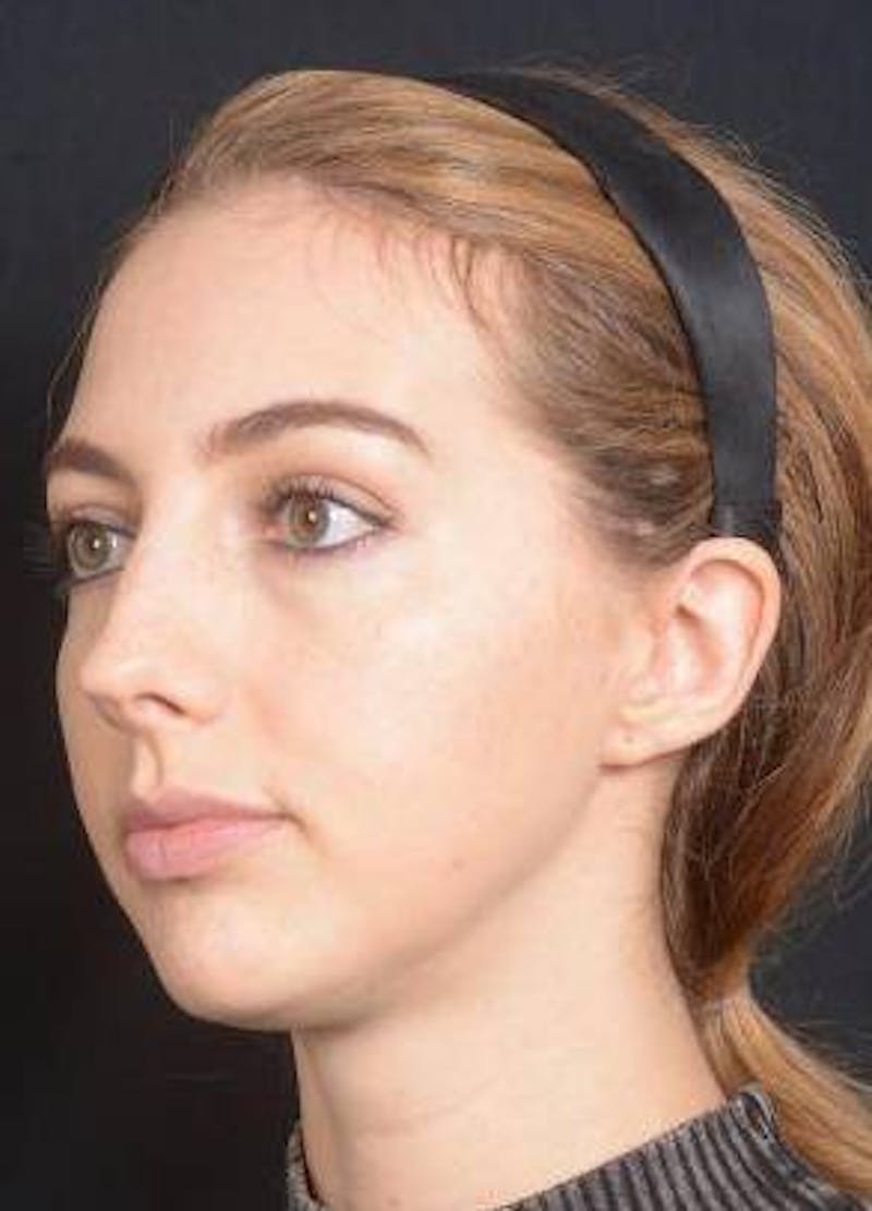 Rhinoplasty Before & After Gallery - Patient 385171 - Image 7