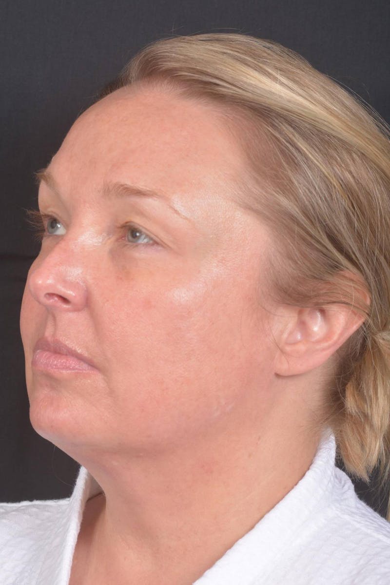 Facelift Before & After Gallery - Patient 125952 - Image 7