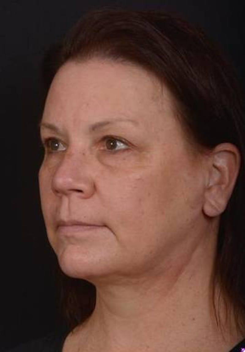 Necklift Before & After Gallery - Patient 374539 - Image 4