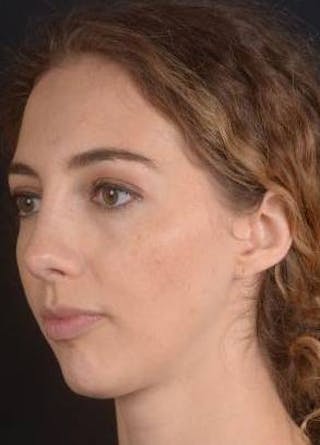 Rhinoplasty Before & After Gallery - Patient 385171 - Image 8